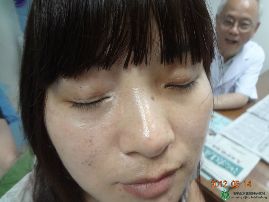 ,白癜风患者