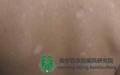 白癜风患者